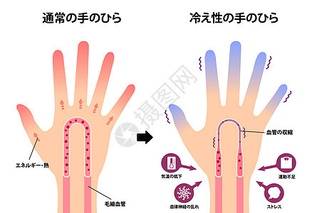 日本正常手和冷手对冷指尖敏感度比较图寒潮寒冷女性疾病温度卡通片蓝色手指血液循环器官背景图片