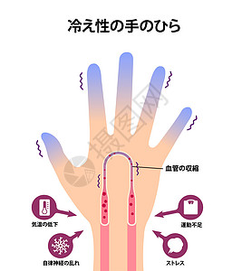 冷手血液循环图示对冷指尖的敏感性身体流感疼痛寒冷状况成人寒潮插图卡通片疾病图片