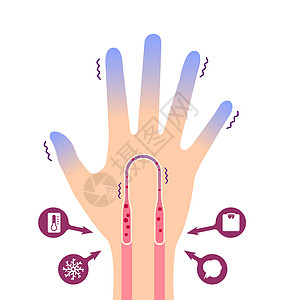 冷手血液循环图示对冷指尖的敏感性蓝色成人寒冷女士卡通片插图疾病手臂温度器官图片