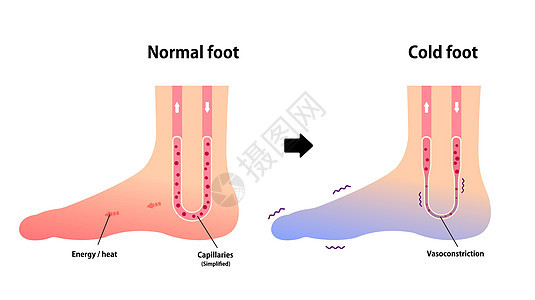 正常足和冷足对冷脚趾敏感度的比较图症状插图卡通片女士身体疼痛寒潮流感女性器官背景图片