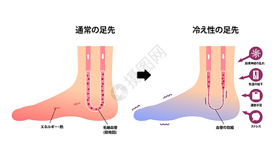 日本正常脚和冷脚对冷脚趾敏感度的比较图解血液循环女性寒潮寒冷温度女士流感器官状况症状图片