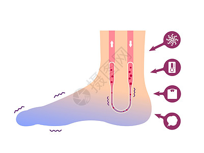 冷脚血液循环插图对寒冷脚趾的敏感性 No tex状况卡通片器官蓝色疾病流感女性温度症状寒潮图片