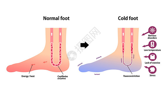正常足和冷足对冷脚趾敏感度的比较图疾病器官身体症状状况寒冷插图流感疼痛女性图片