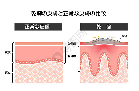 日本牛皮癣和正常皮肤平面矢量图解的横截面图片