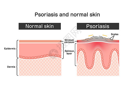 牛皮癣和正常皮肤平面矢量图案的横截面牌匾过敏斑块皮炎治疗科学疼痛荨麻疹真皮表皮图片