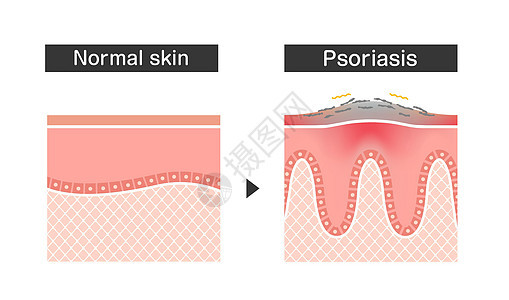 牛皮癣和正常皮肤平面矢量图案的横截面感染疾病皮疹真皮皮肤科疱疹科学过敏疼痛解剖学图片