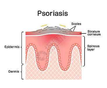 牛皮癣皮肤扁平载体它制作图案的横截面牌匾插图解剖学皮炎表皮荨麻疹过敏身体感染疾病图片