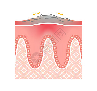 牛皮癣皮肤扁平载体它制作图案的横截面症状药品疼痛细胞皮肤科身体治疗牌匾斑块表皮图片