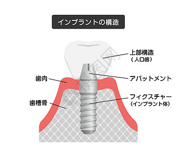 它制作图案的牙科植入物平面矢量假牙诊所药品横截面假肢磨牙卡通片搪瓷凹痕渲染图片