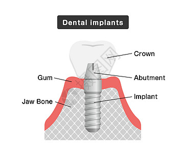 它制作图案的牙科植入物平面矢量横截面磨牙陶瓷卡通片牙齿渲染假肢治疗牙龈外科图片