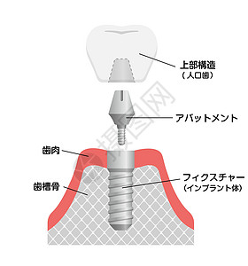 它制作图案的牙科植入物平面矢量卡通片外科治疗假肢牙医医院牙齿制品解剖学渲染图片