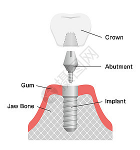 它制作图案的牙科植入物平面矢量插图手术药品制品凹痕渲染卡通片牙龈假牙横截面图片