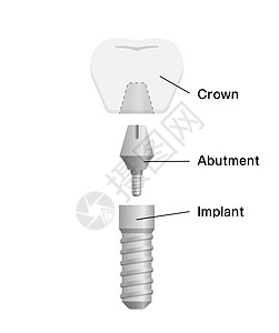 它制作图案的牙科植入物平面矢量渲染诊所卡通片解剖学磨牙横截面医院牙龈假肢牙齿图片