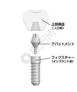 牙种植体平面矢量图日本假牙插图渲染凹痕牙齿解剖学药品牙医磨牙陶瓷图片