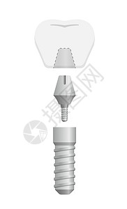 牙科植入物平面矢量图 No tex解剖学假肢外科牙医口服医院药品制品牙龈磨牙图片