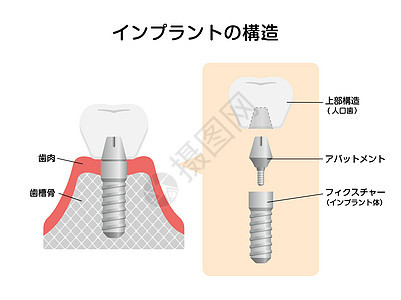 牙种植体平面矢量图日本制品牙齿凹痕牙龈口服植入物假牙渲染手术搪瓷图片
