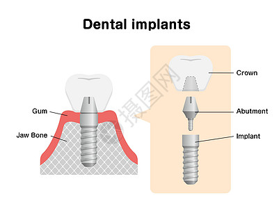 它制作图案的牙科植入物平面矢量搪瓷牙齿诊所外科假肢假牙手术解剖学磨牙牙医图片