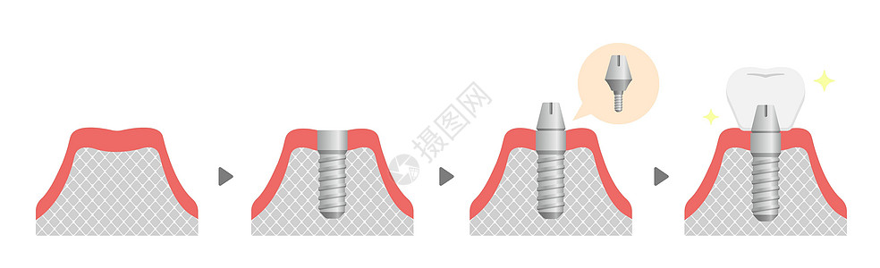 牙科植入过程平面矢量图无 tex植入物搪瓷假牙制品牙龈陶瓷解剖学手术药品渲染图片