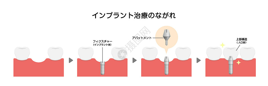 牙科植入过程平面矢量图日本制品植入物假肢牙龈手术陶瓷假牙治疗诊所口服图片