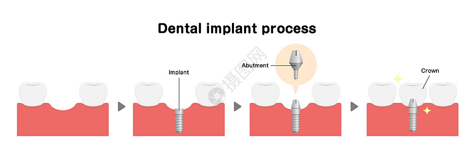 它制作图案的牙种植体过程平面矢量治疗假肢牙龈搪瓷卡通片植入物医院渲染插图横截面图片