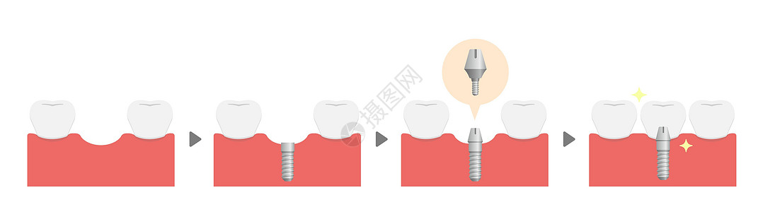 牙科植入过程平面矢量图无 tex卡通片假牙牙医搪瓷磨牙诊所牙齿渲染手术插图图片