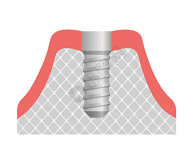 牙科植入物平面矢量图植入颌骨牙龈磨牙手术医院解剖学搪瓷陶瓷横截面假肢牙医图片