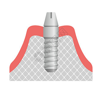 牙科植入物平面矢量图 连接基台陶瓷药品解剖学假肢牙龈医院磨牙假牙诊所搪瓷图片