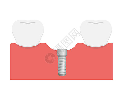 牙科植入物平面矢量图植入颌骨插图外科卡通片磨牙横截面陶瓷渲染解剖学诊所牙龈图片