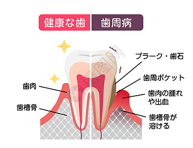 正常牙齿和牙周病的比较 平面矢量图清洁度口腔医疗插图牌匾牙医本质感染疾病搪瓷图片