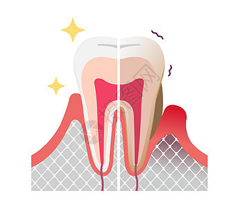正常牙齿和牙周病的比较 平面矢量图清洁度医疗牙科牙周口服解剖学横截面本质插图疾病图片