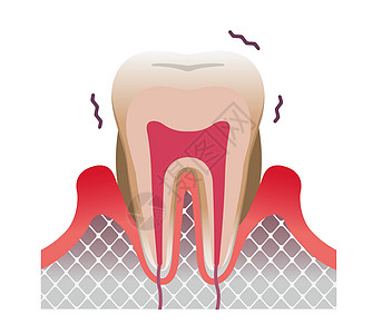 牙周病牙齿和牙龈平面矢量图图片
