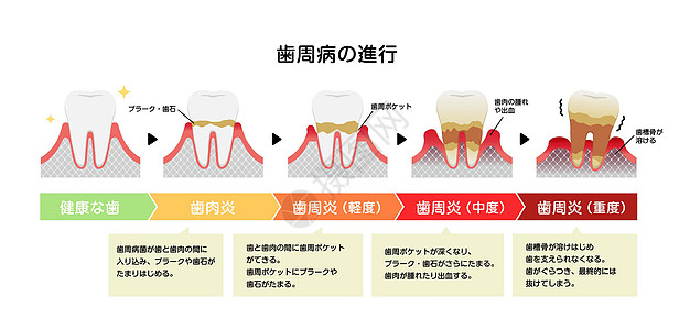 牙周炎病媒它制作图案的阶段保健口腔治疗牙医口臭搪瓷牙齿口服解剖学横截面图片