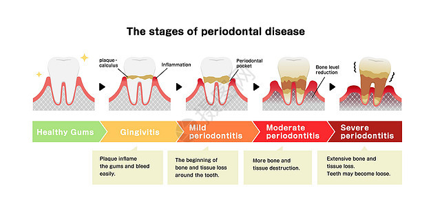 牙周炎病媒它制作图案的阶段牙齿口服疾病插图保健口腔横截面清洁度牙疼医疗图片