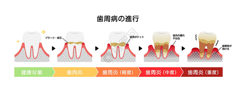 牙周炎病媒它制作图案的阶段解剖学牙科牌匾口臭疾病护理细菌本质清洁度横截面图片