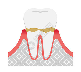 牙周炎牙龈炎的阶段图片