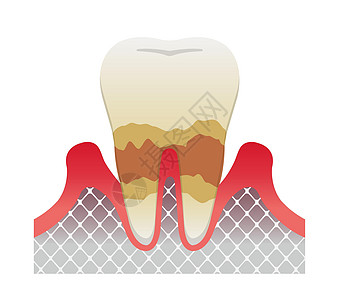 牙齿牙周炎疾病的阶段 中度牙周炎插画