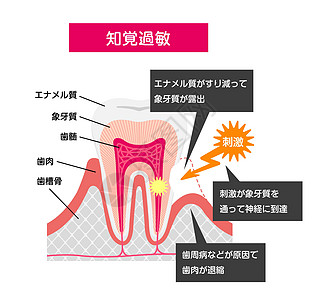 日本牙齿敏感病媒图解的成因与机制健康疼痛症状刺激空腔牙医凹痕诊所搪瓷保健图片