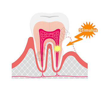 牙齿敏感病媒制作图案的成因及机制痛苦疾病牙科症状刺激卡通片牙医凹痕疼痛口服图片