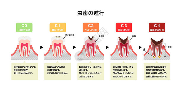 日本蛀牙平面矢量图解的各个阶段搪瓷解剖学本质感染牙医信息牙齿图表插图牙疼图片