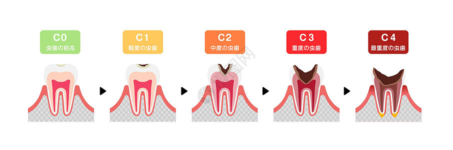 日本蛀牙平面矢量图解的各个阶段感染磨牙信息诊所王冠衰变搪瓷健康牙医脓肿图片