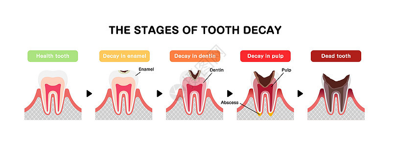 蛀牙平面向量它制作图案的阶段插图衰变保健诊所卫生脓肿磨牙牙医治疗健康图片