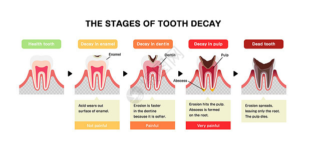 蛀牙平面向量它制作图案的阶段治疗脓肿搪瓷感染牙疼保健图表衰变解剖学磨牙图片