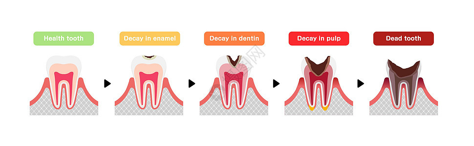 蛀牙平面向量它制作图案的阶段磨牙疾病解剖学图表脓肿搪瓷衰变空腔卡通片卫生图片