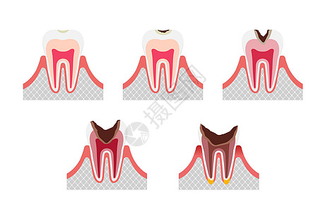 蛀牙平面矢量图解 se 的阶段图片
