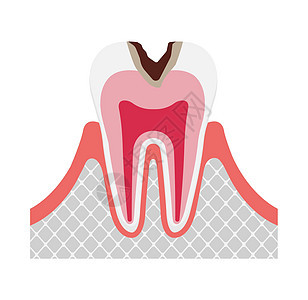 蛀牙的阶段牙医王冠图表插图疼痛本质信息解剖学脓肿搪瓷图片