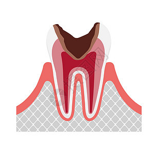 蛀牙的阶段本质疼痛健康插图卫生疾病牙医治疗信息图表图片