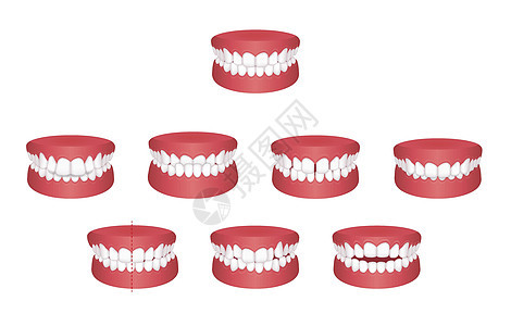 牙齿麻烦咬类型矢量图 se假牙覆合插图牙列拔牙矫正双牙空腔疾病治疗背景图片