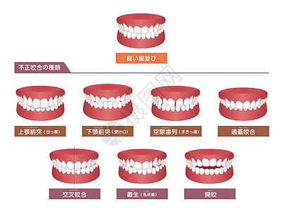 牙齿麻烦咬类型矢量图 se矫正治疗疾病牙医诊所双牙牙列插图假牙空腔图片