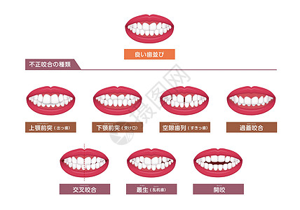 牙齿麻烦咬合型歪牙矢量图 se插图假牙空腔拔牙牙列矫正诊所双牙覆合治疗图片