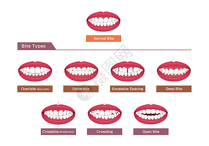 牙齿麻烦咬合型歪牙矢量图 se拔牙治疗牙列双牙疾病覆合3d拥挤口服牙科图片